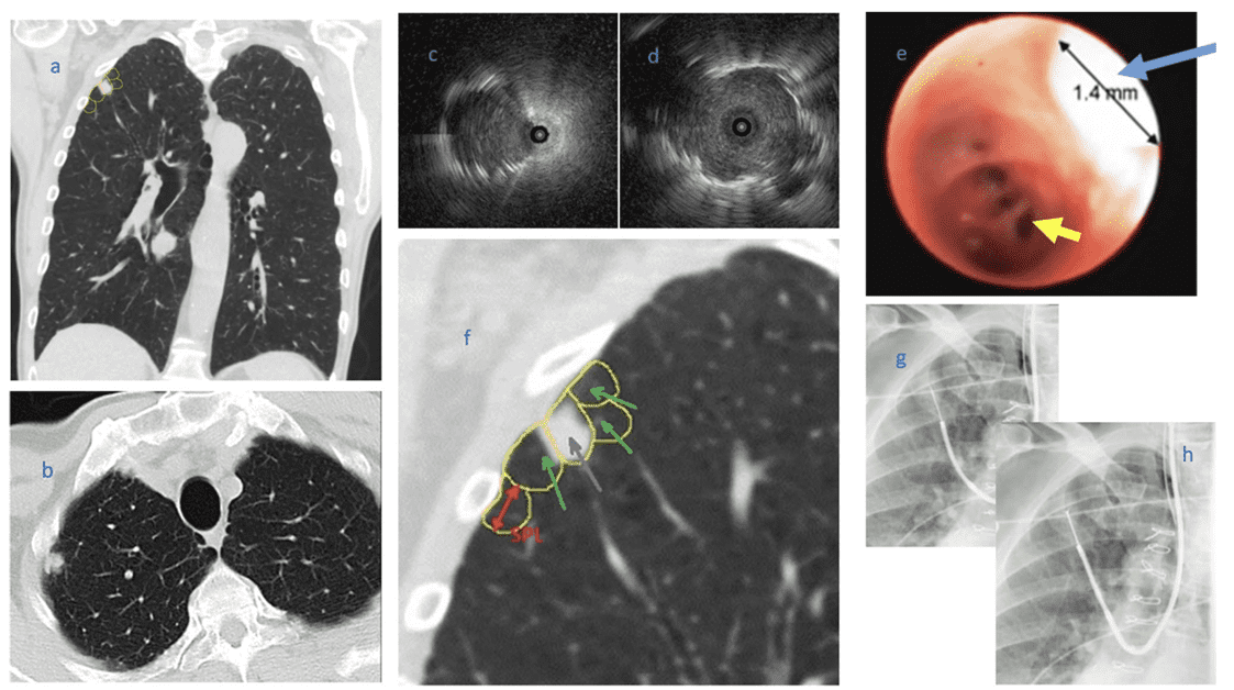 Ultrathin Bronchoscopy Without Virtual Navigation for Diagnosis of Peripheral Lung Lesions