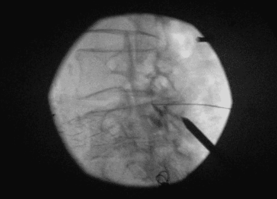 Long-term Safety and Efficacy of Minimally Invasive Lumbar Decompression Procedure for the Treatment of Lumbar Spinal Stenosis With Neurogenic Claudication: 2-Year Results of MiDAS ENCORE
