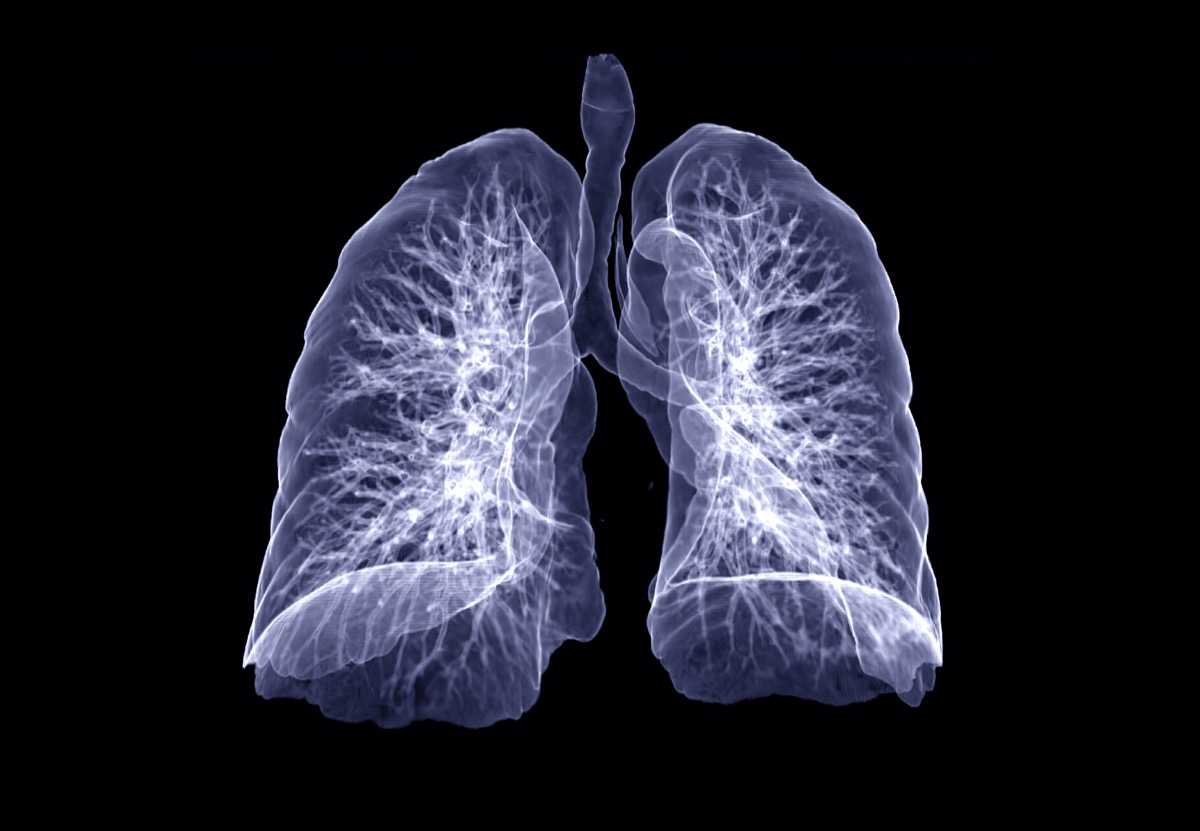 Diagnostic Evaluation of Pulmonary Embolism During the COVID-19 Pandemic