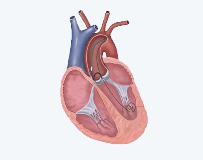 First-in-Man Study Evaluating the Emblok Embolic Protection System During Transcatheter Aortic Valve Replacement