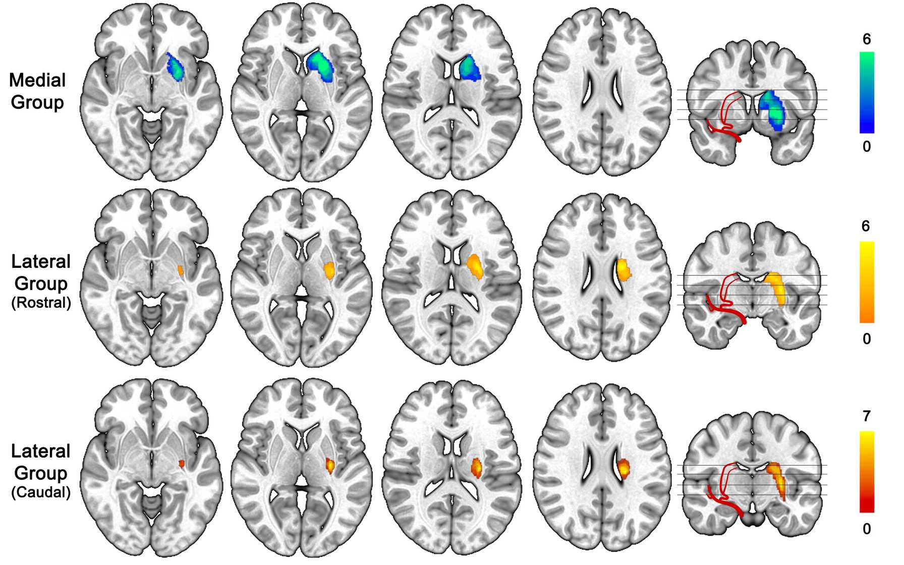 Three-Dimensional Maps of the Lenticulostriate Artery Territory