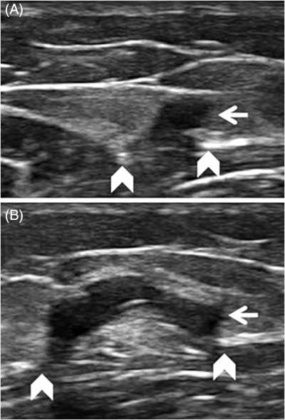 ultrasound showing muscle herniation