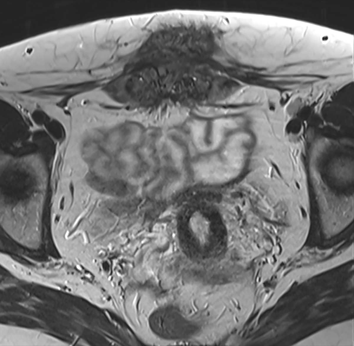 Spontaneous Abdominal Wall Endometriosis: Minimally Invasive Surgery for Excision and Repair