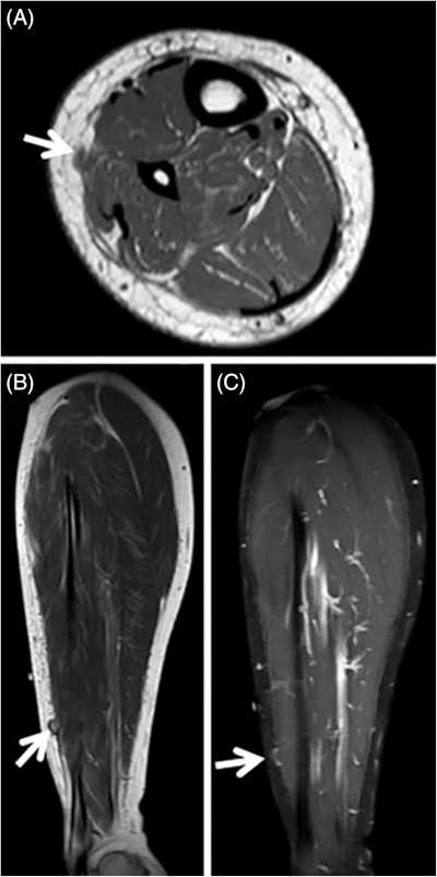 Nerve entrapments related to muscle herniation
