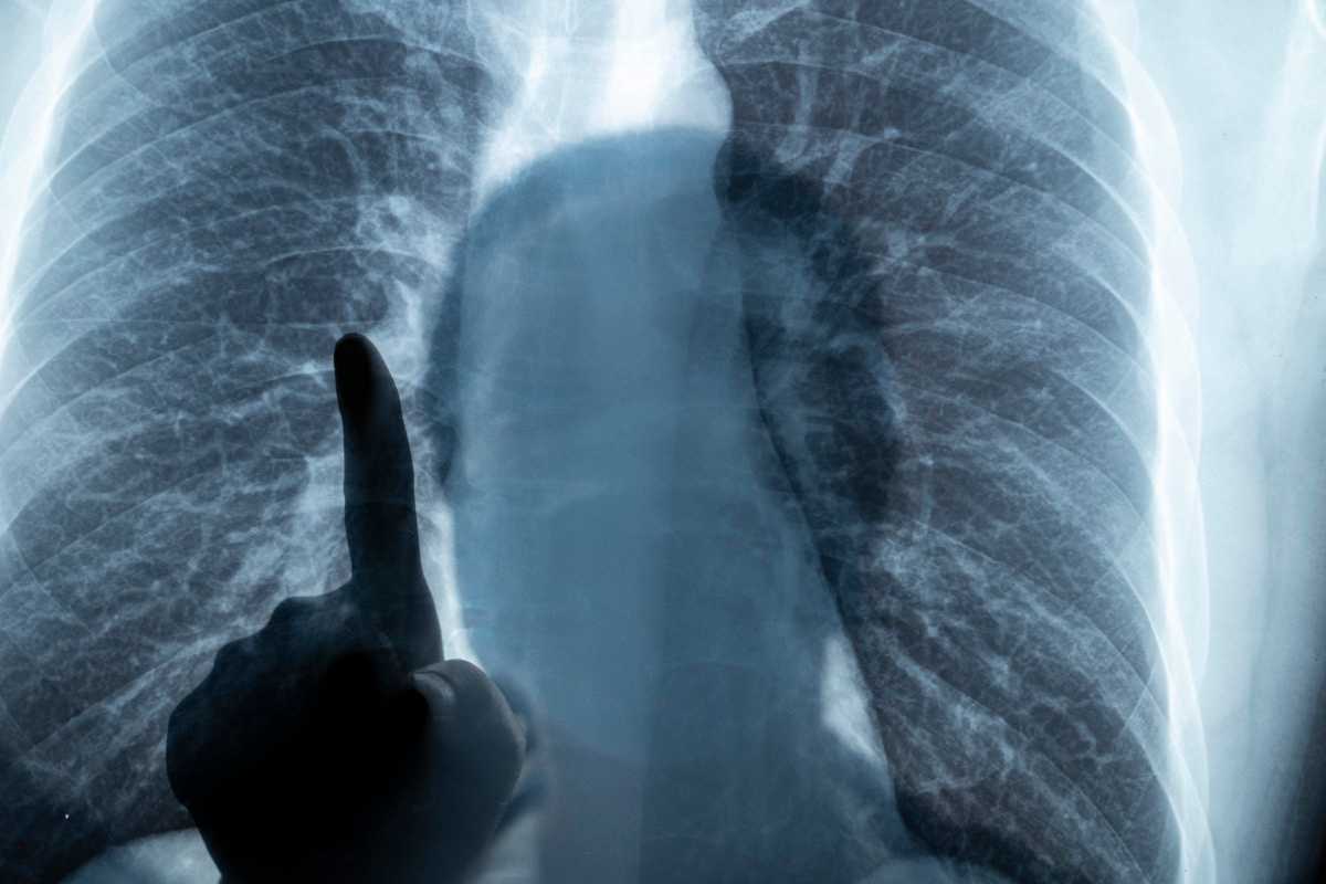 Twenty-Year Reflection on the Impact of World Trade Center Exposure on Pulmonary Outcomes in Fire Department of the City of New York (FDNY) Rescue and Recovery Workers