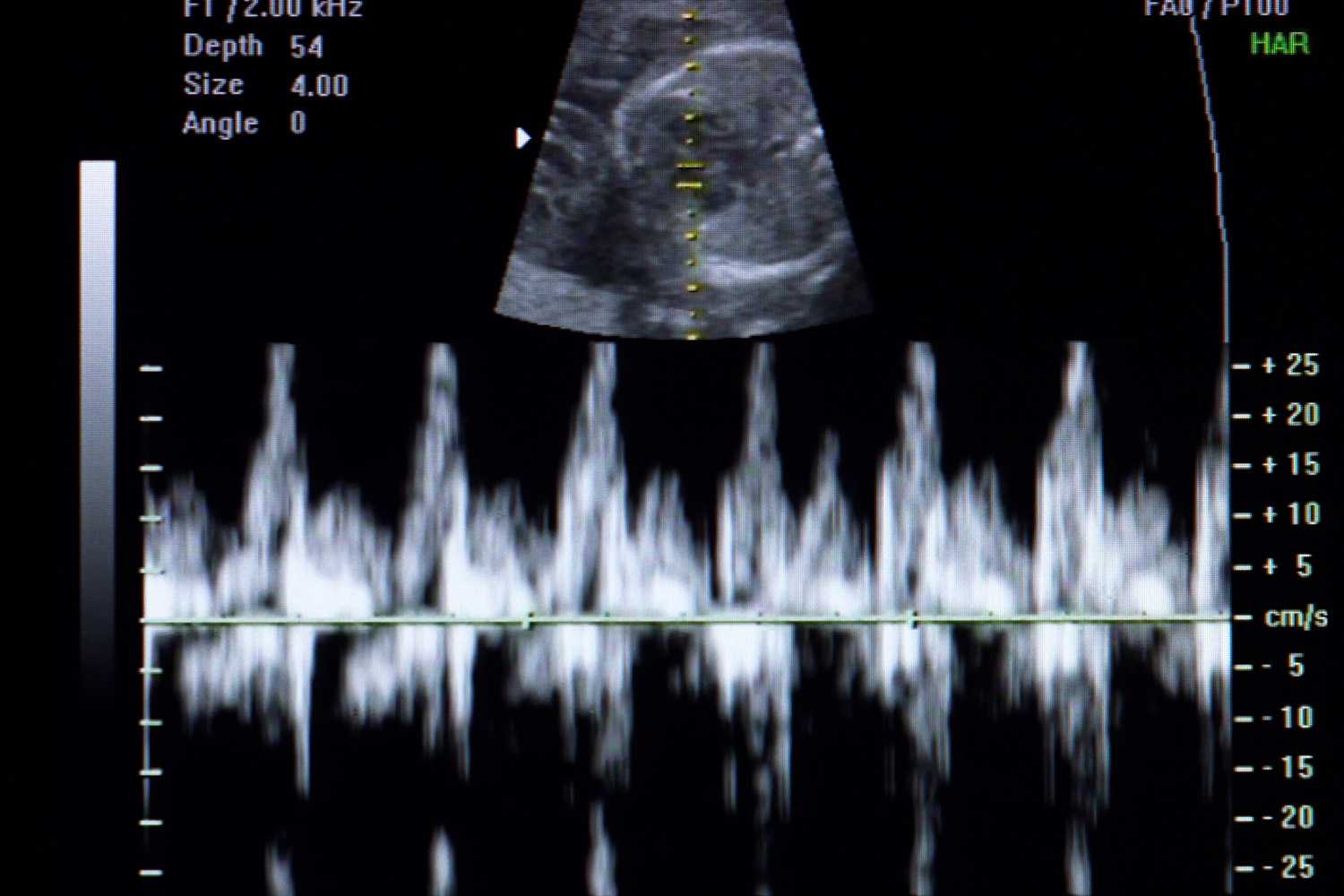 Pharmacological Management of Cardiac Arrhythmias in the Fetal and Neonatal Periods