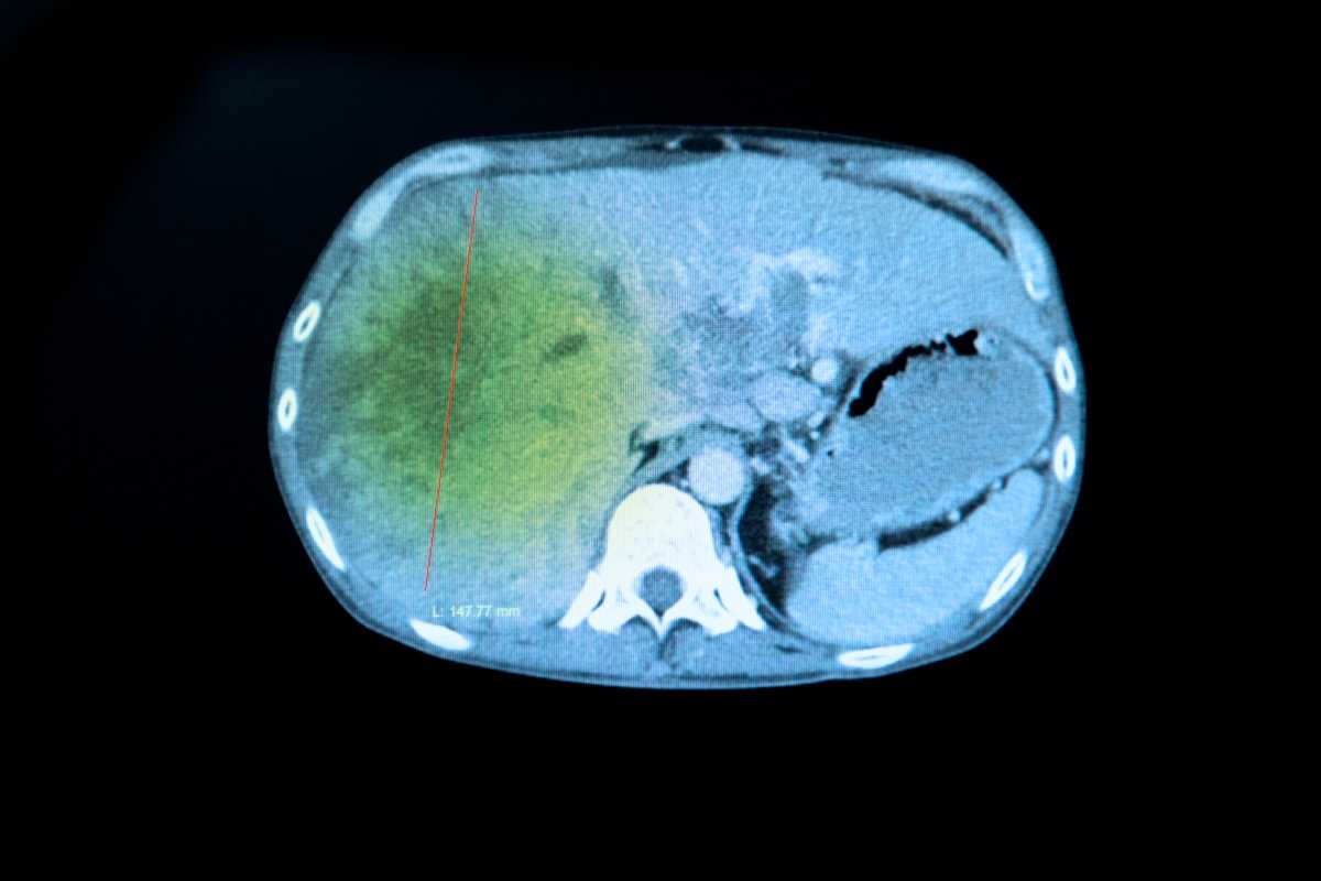 Liver Imaging Reporting and Data System (LI-RADS) Version 2018: Imaging of Hepatocellular Carcinoma in At-Risk Patients