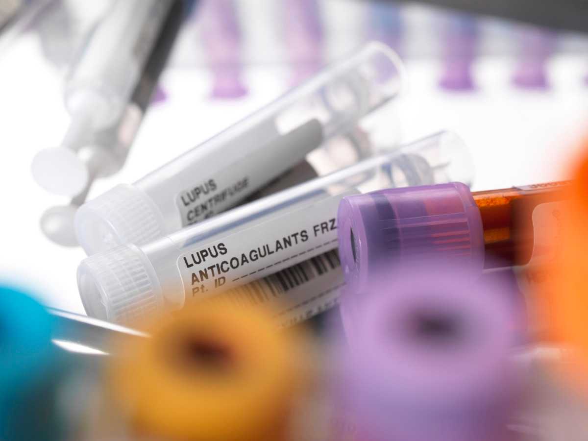 Assessment of Lupus Anticoagulant Positivity in Patients With Coronavirus Disease 2019 (COVID-19)