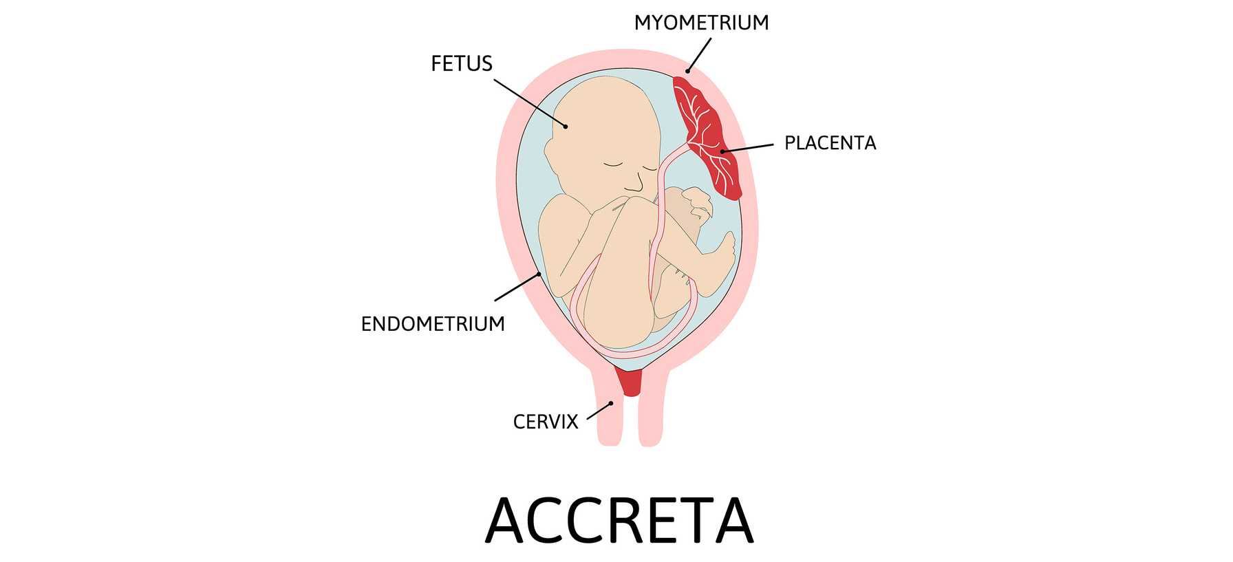Investigation of Health Inequities in Maternal and Neonatal Outcomes of Patients with Placenta Accreta Spectrum: A Multicenter Study