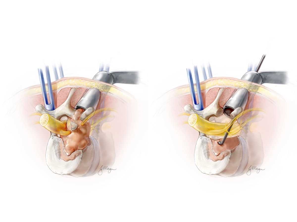 Minimally Invasive Separation Surgery with Intraoperative Stereotactic Guidance: A Feasibility Study