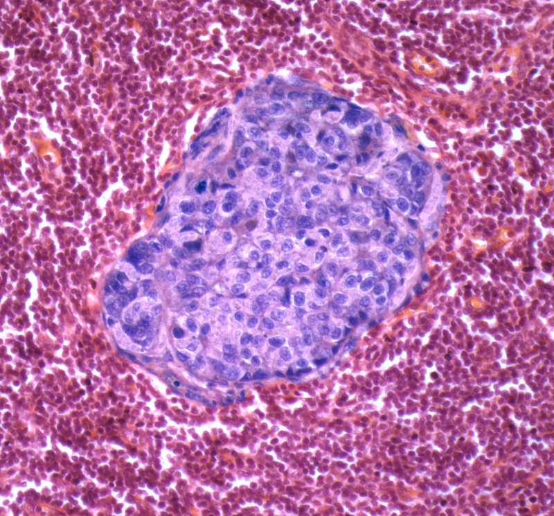 Image of metastatic breast cancer