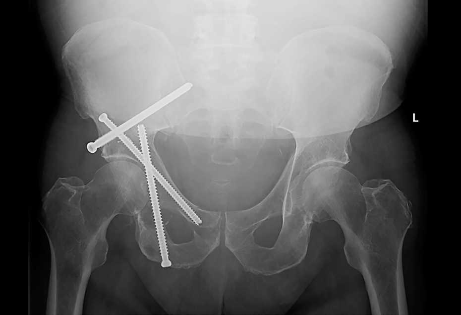 A Novel Tripod Percutaneous Reconstruction Technique in Periacetabular Lesions Caused by Metastatic Cancer