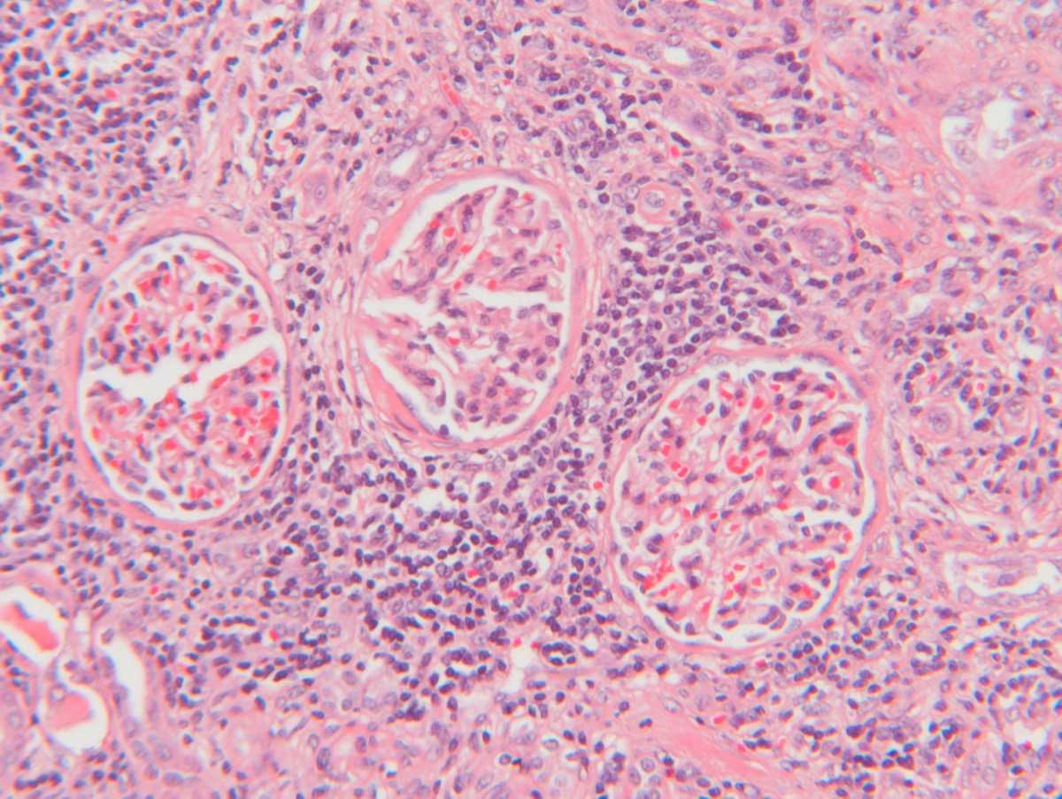 Tubulointerstitial Damage Predicts End-stage Renal Disease in Lupus Nephritis with Preserved to Moderately Impaired Renal Function: A Retrospective Cohort Study