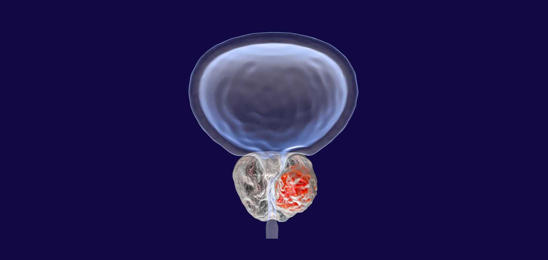 Preserving Erectile Function Following Prostate Cancer Surgery