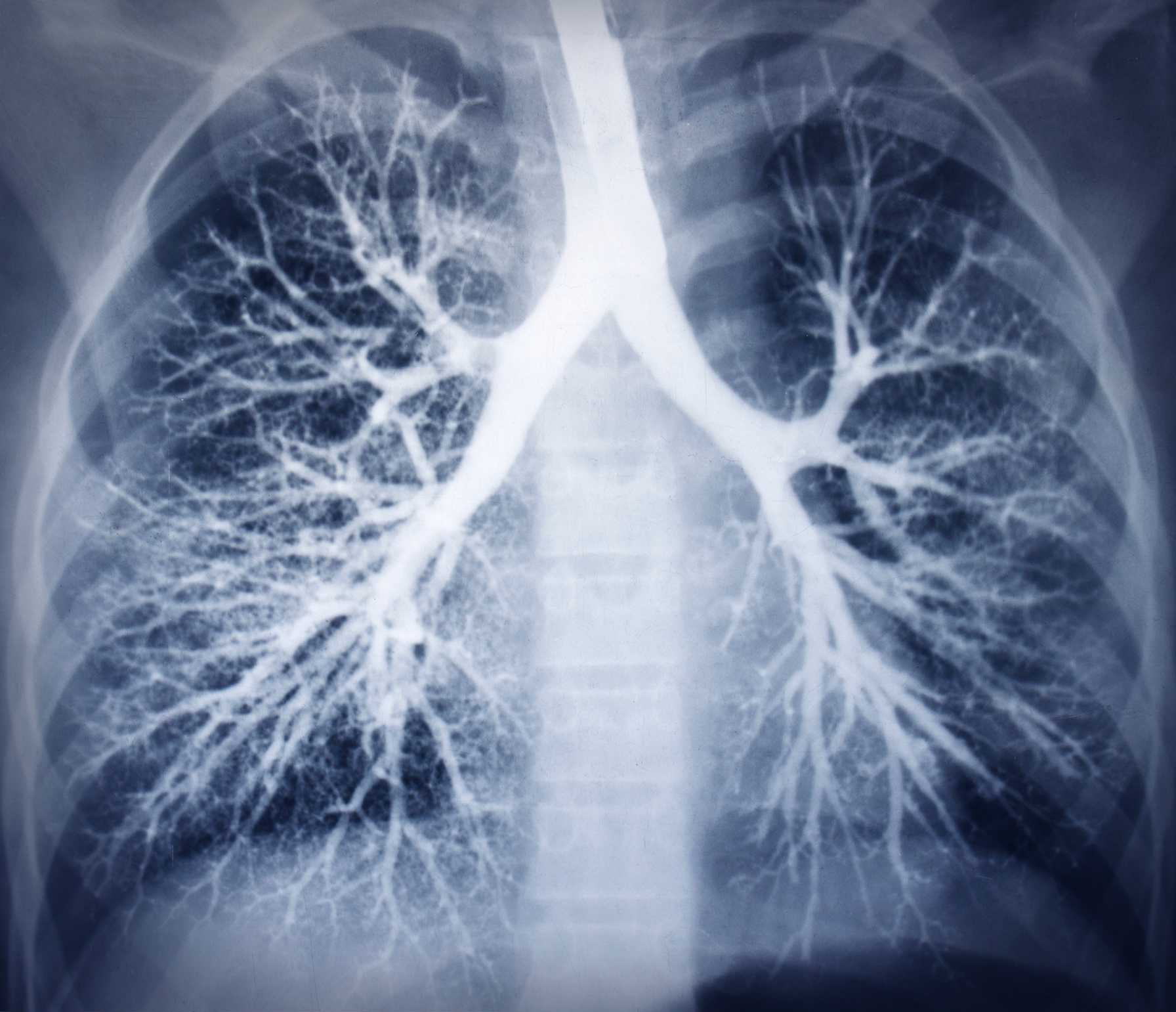X-ray image of human lungs showing detailed bronchial tree structure.